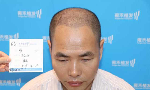 秃头改善案例