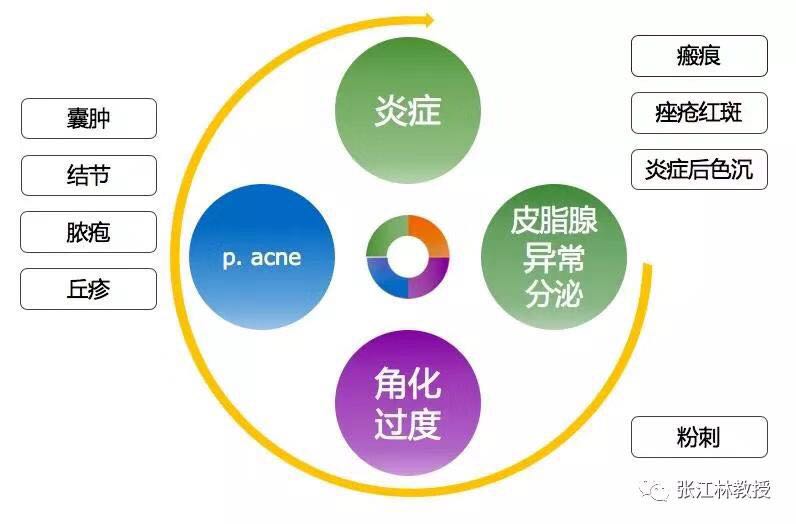 痤疮发病机制