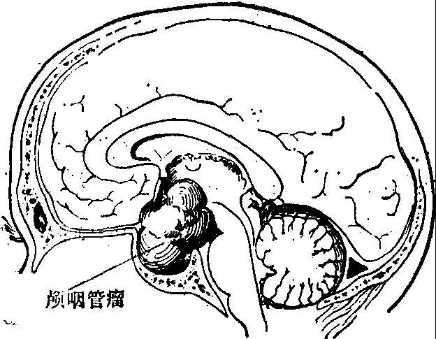 颅咽管瘤解剖位置图片