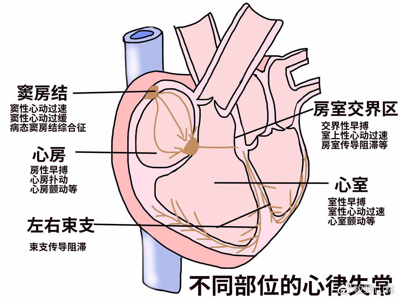 第一类致命性心律失常,这其中最危险的要数心室颤动和心室扑动,这个不