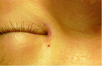 下图中内眼角的凹陷疤痕很常见,是开内眼角留下的,临床上也常常缺少好