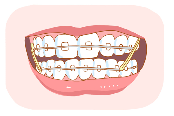 不管是隱形矯正還是固定矯正,醫生都可能會需要你自行配戴橡皮筋,掛在