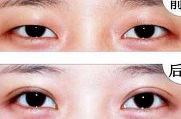 眼部脂肪比较多,适合割双眼皮吗?