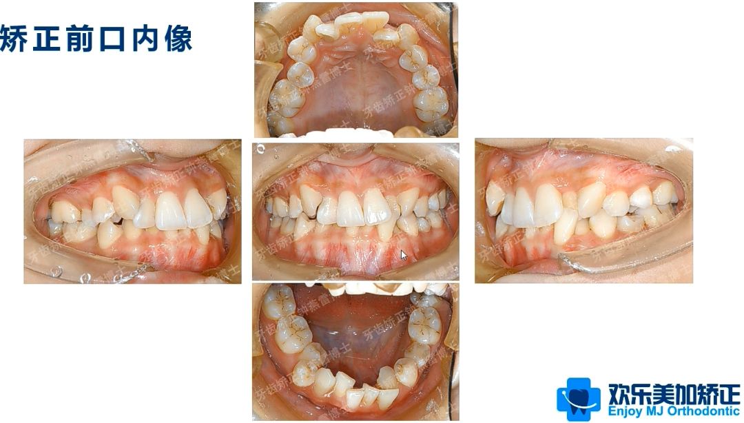 自从治好了双层牙,什么情况下都可以开怀大笑啦!