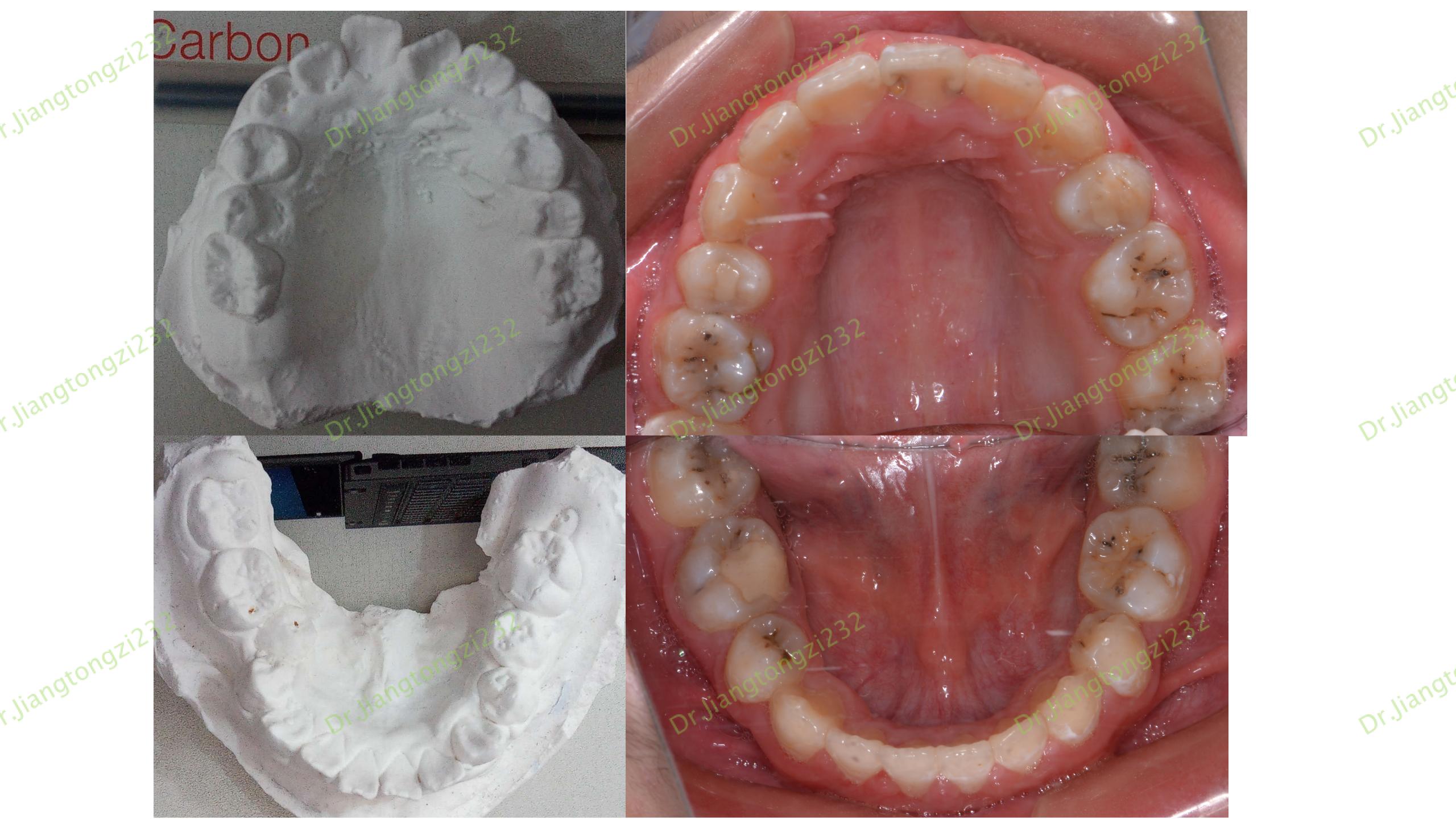 《正畸案例47:牙齿矫正后的牙面白斑》