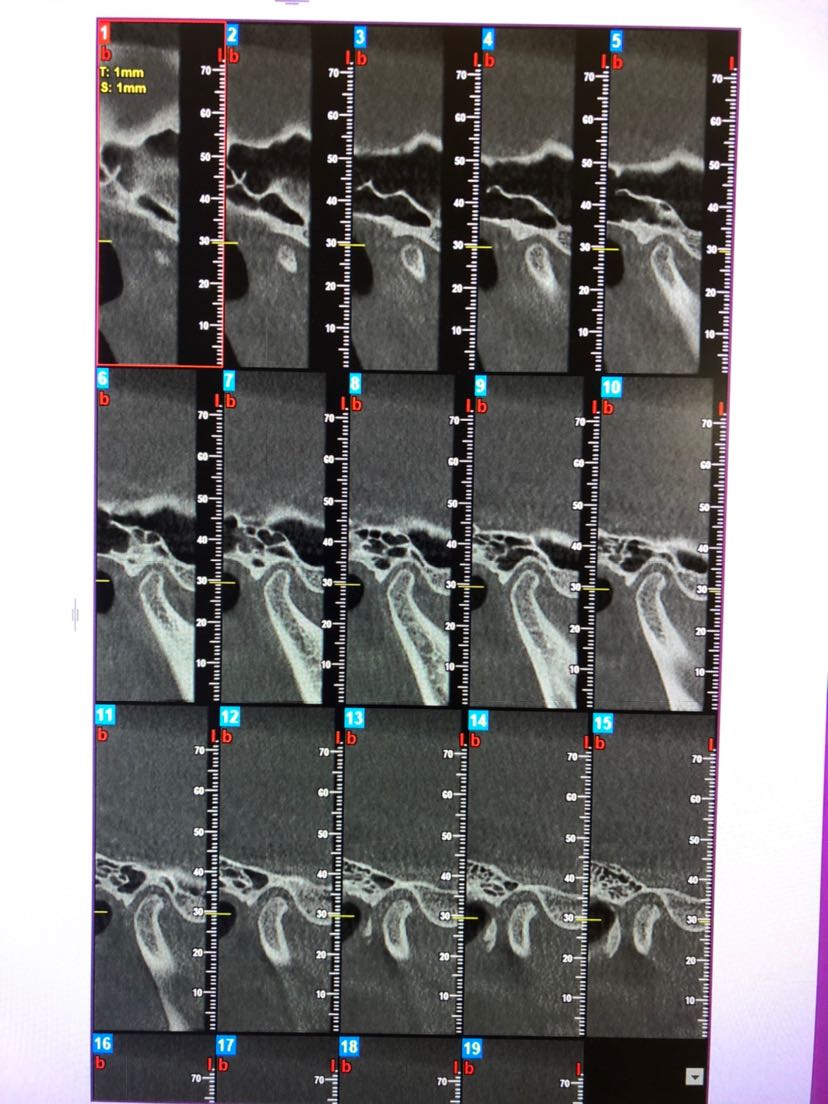 关节盘不可复性移位怎么办
