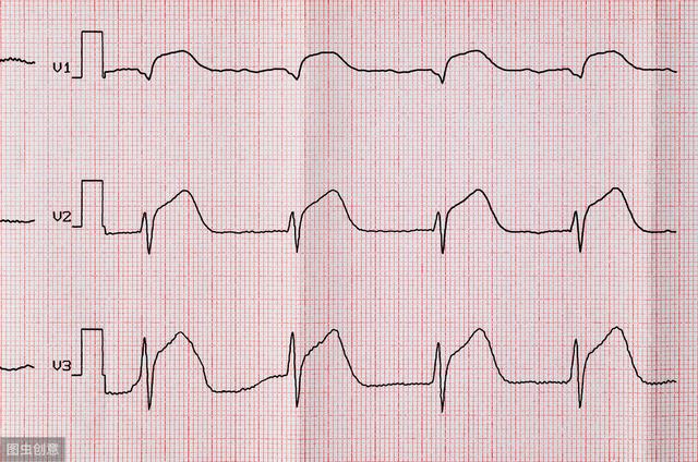 心电图写着t波倒置就是心肌缺血吗医生不能如此草率