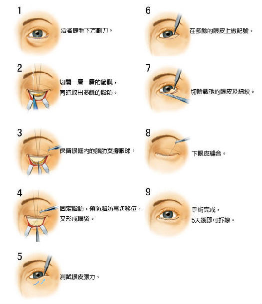 比眼霜有用1万倍的去眼袋手术