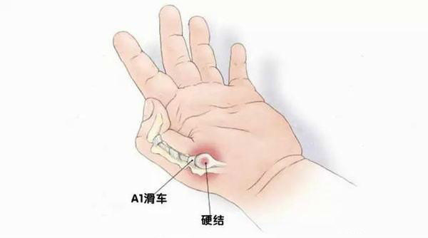 拿手机的手指已严重变形且很痛应该怎么办