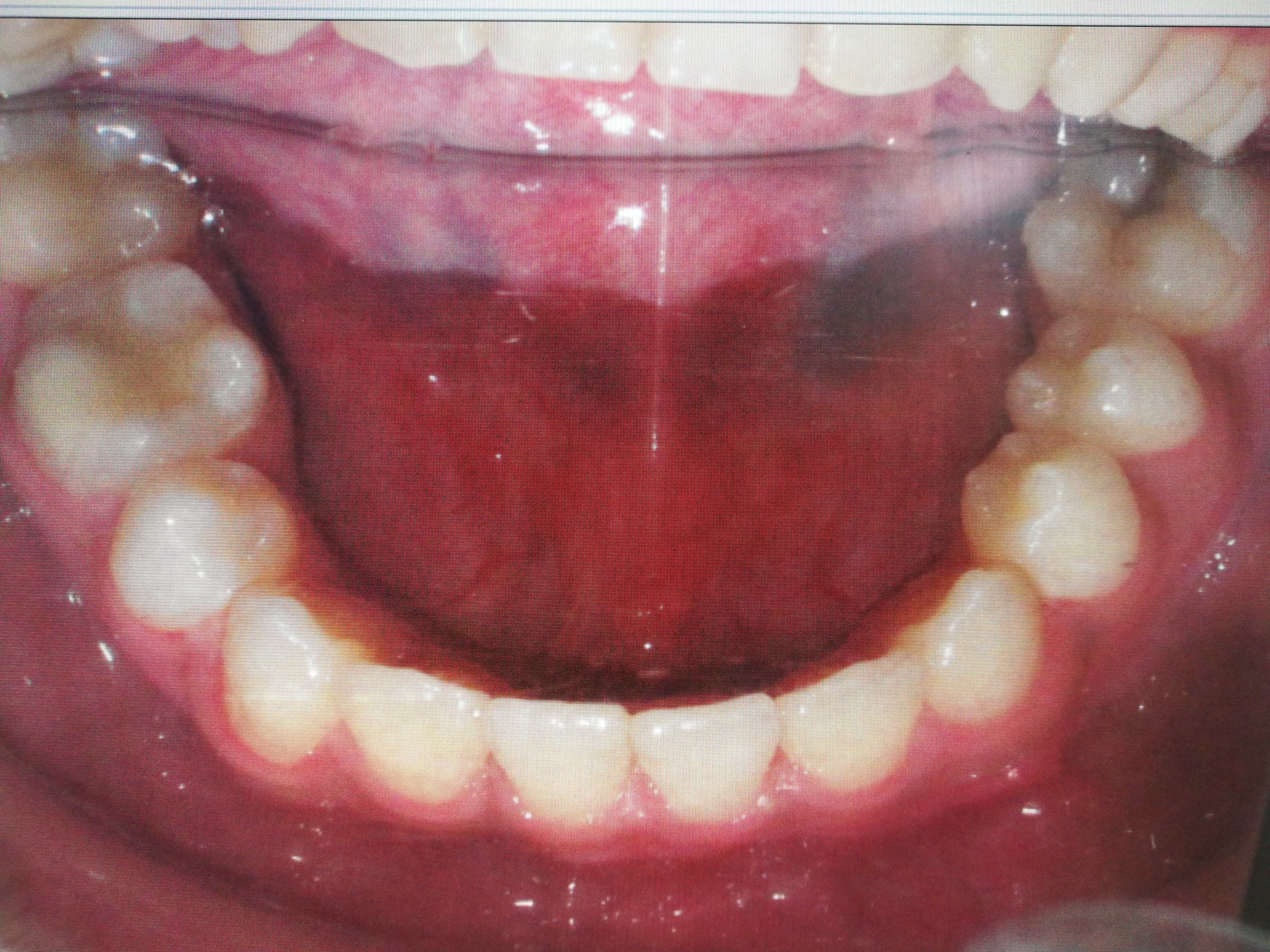 缺失的牙齿除了种植修复外,还能怎么办?
