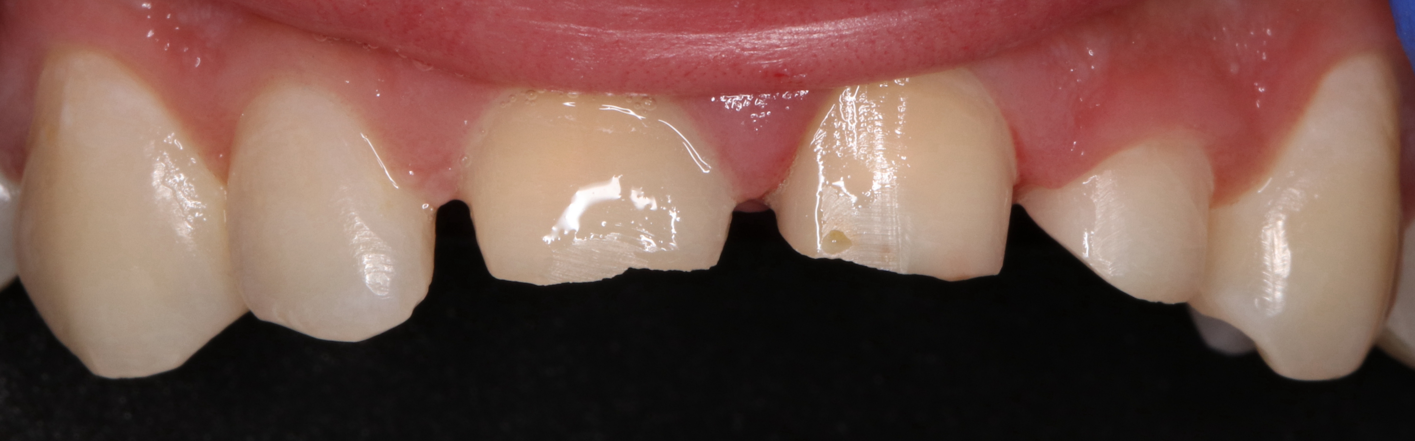 门牙外伤修复治疗