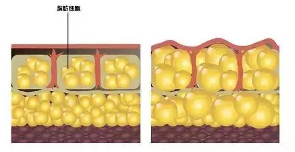 脂肪填充术后如何护理