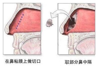 鼻整形常用的鼻中隔軟骨,取出之後鼻子會塌嗎?