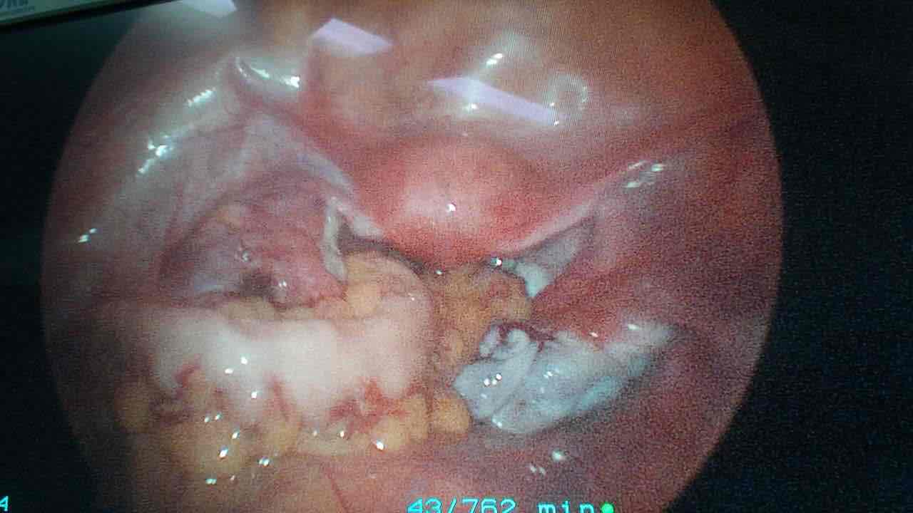 尿道外口囊肿图片