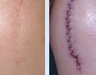 疤痕常用治疗方法大全及其选择