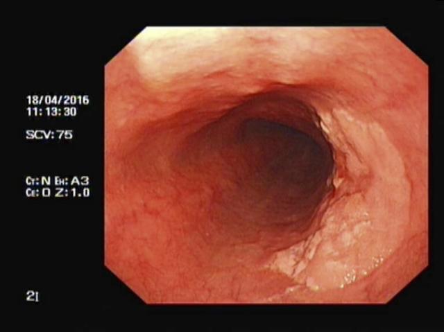 早期食管癌图片早期胃癌图片早期大肠癌图片第二,针对癌前病变.
