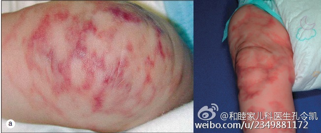 是胎记?是痣?凶恶的"天使之吻"