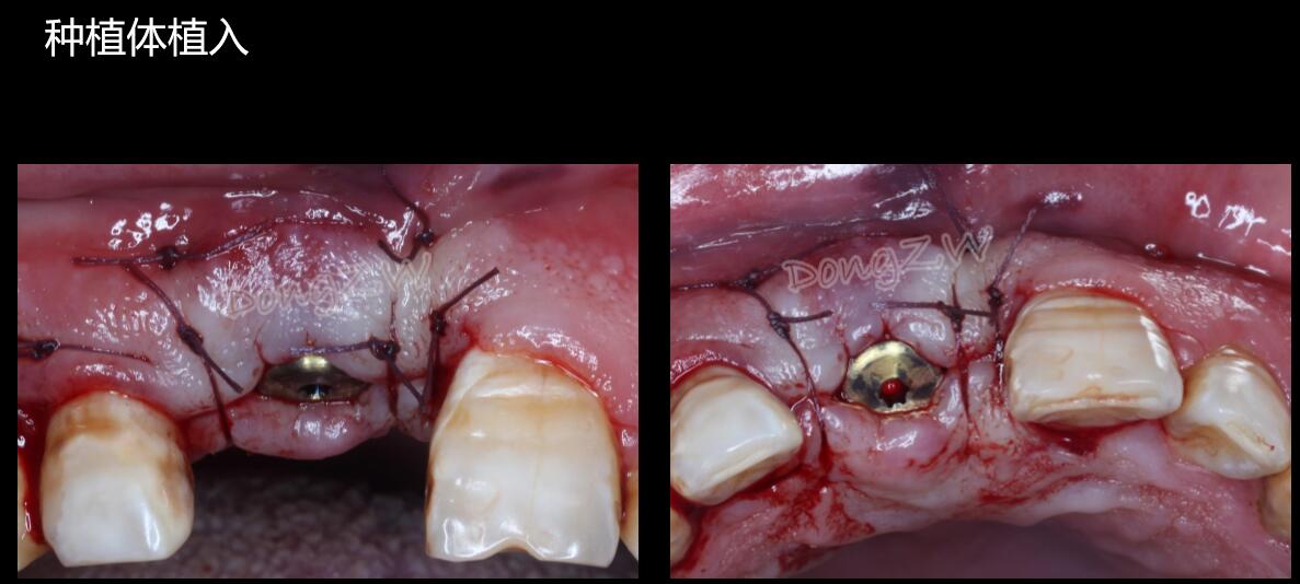 门牙松动onlay植骨种植案例