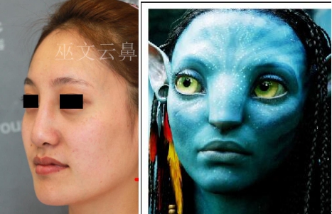 拒绝阿凡达,玻尿酸隆鼻到底能不能做?