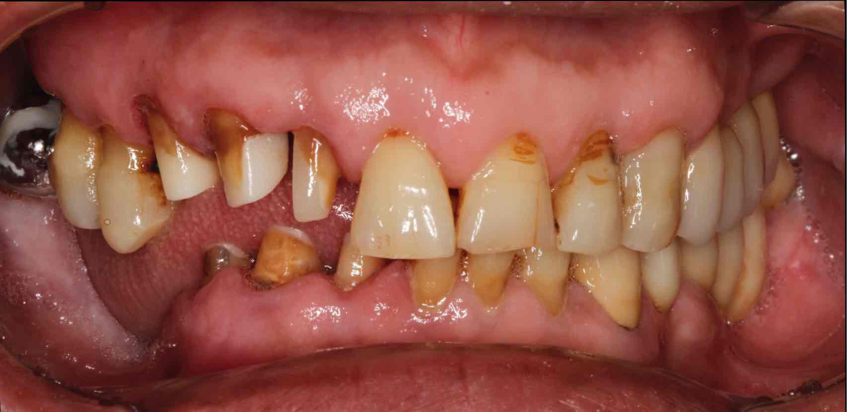 精密附着体修复失败牙槽骨严重萎缩再修复案例