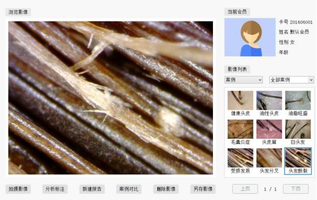 放大头皮画面,可以很直观的看到:头皮的颜色,毛囊萎缩坏死情况和毛囊