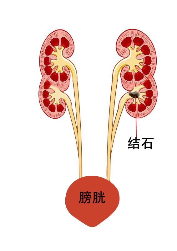 肾结石示意图图片