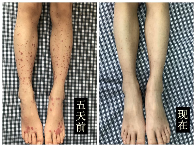 前几天收入院一个过敏性紫癜的小女孩,8岁,发病前1周得了疱疹性咽峡炎