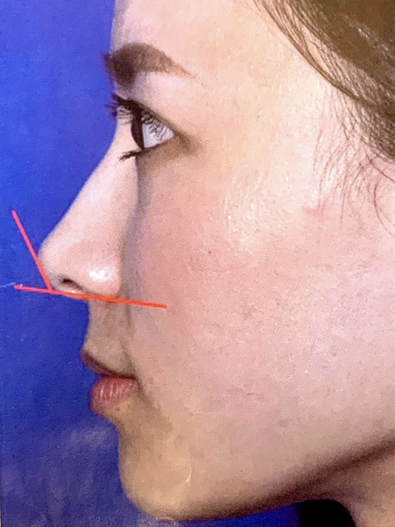 标准鼻小柱图片