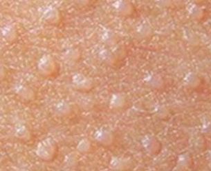 扁平苔藓,蜡样光泽,可见wicknam纹