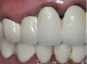 不知道什么时候牙龈边上突然发黑了,本来和牙齿一个颜色的烤瓷牙冠