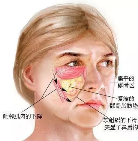 它的下移使中面部組織向下走行,堆積在下面部,與鼻基底合力擠出了法令