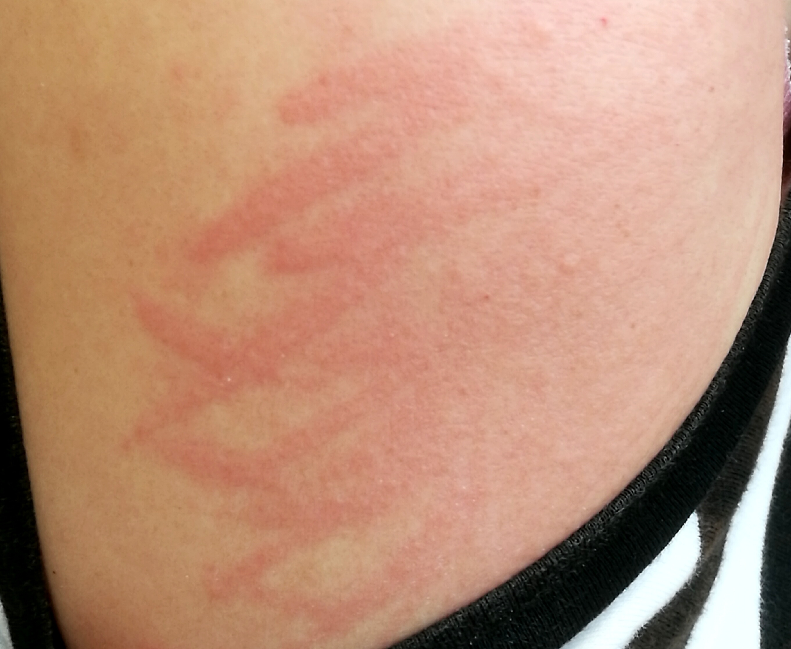 水过敏?千奇百怪的荨麻疹!