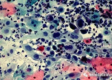 造血祖细胞集落培养发现cml骨髓祖细胞与外周血祖细胞