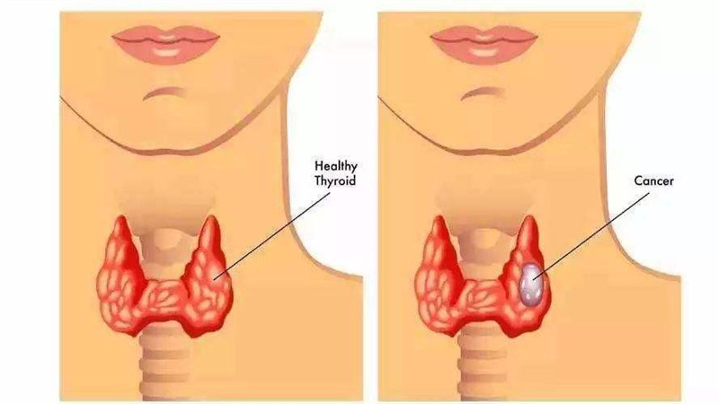 新生儿出现甲状腺功能异常需不需要治疗