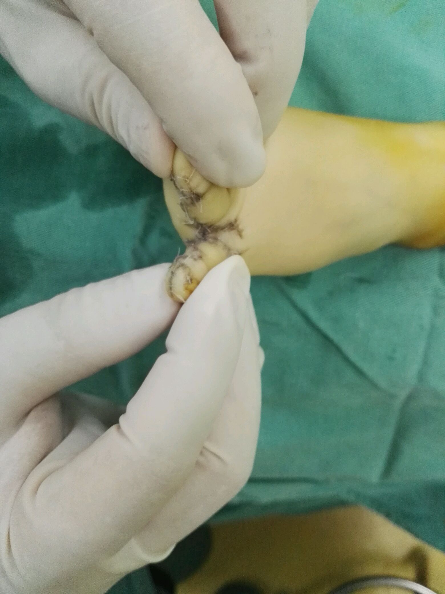 多趾并趾畸形手术要趁早