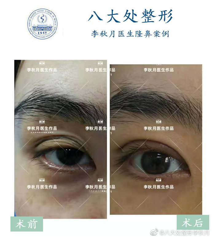 先天性小睑裂综合症应该如何矫正?