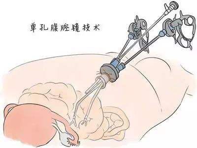 做腹腔镜手术我们需要一个镜头也就是观察孔,一般是在肚脐的位置.