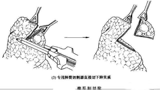 稳定,有些在随访若干年后进入加速生长期,肺原位癌早期切除可以根治