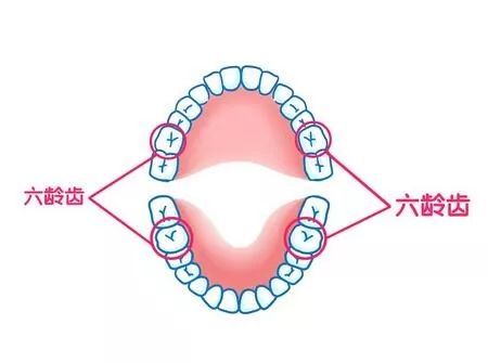 六龄牙是在6岁左右萌出的4颗大牙,医学上叫第一恒磨牙(伴随一生的牙齿