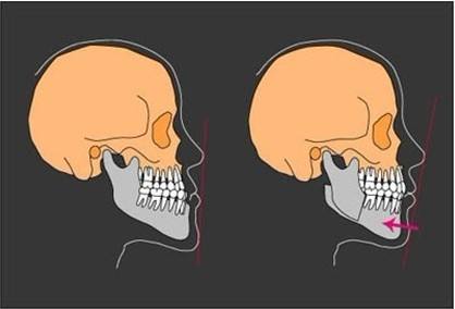 2.反颌,可以通过双鄂手术来矫正,也是在中国被称为地包天的;1.