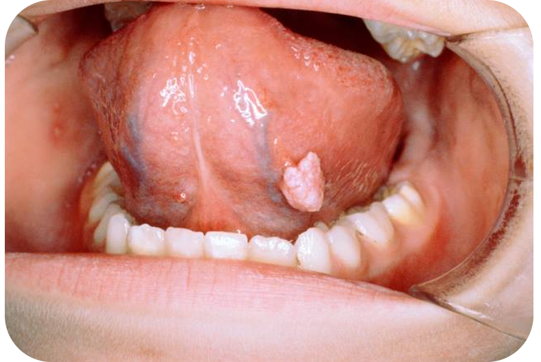 口腔疣初期图片图片