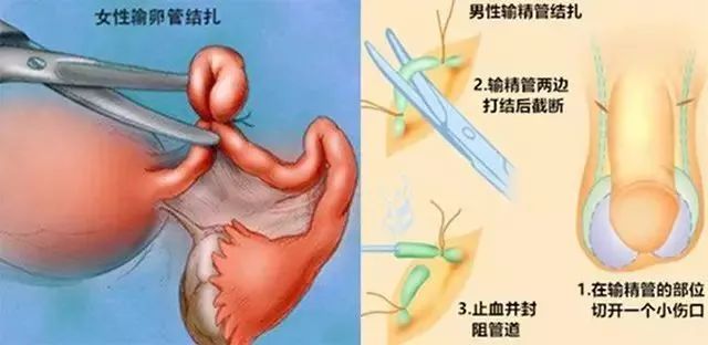 结扎示意图图片