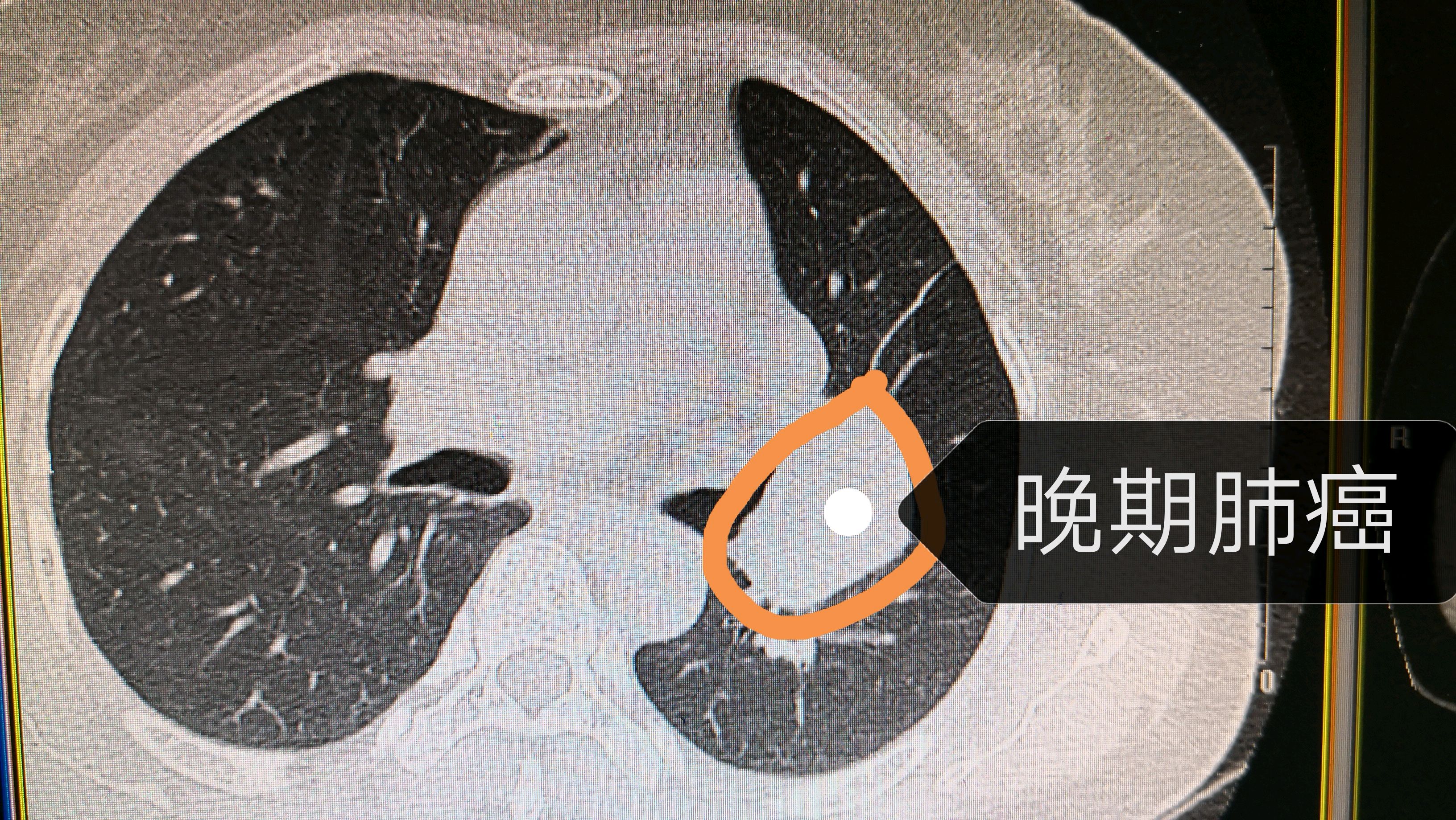 一照ct肺有小结节我会是肺癌吗