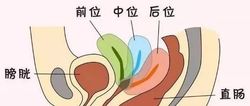 子宫体部与宫颈部的关系,分为前倾前屈(宫体向宫颈方向前屈)和后位的