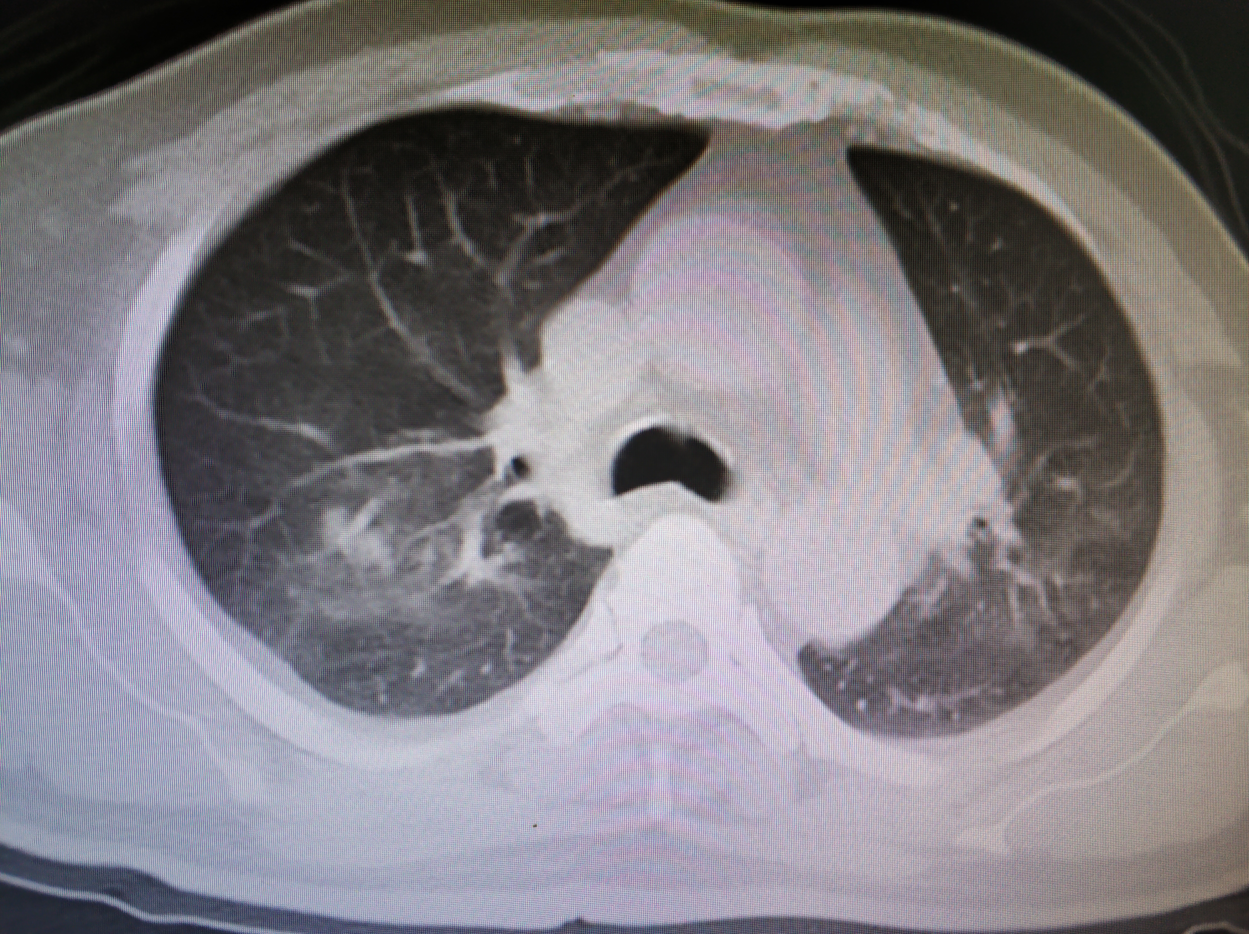 没有任何症状的肺结核