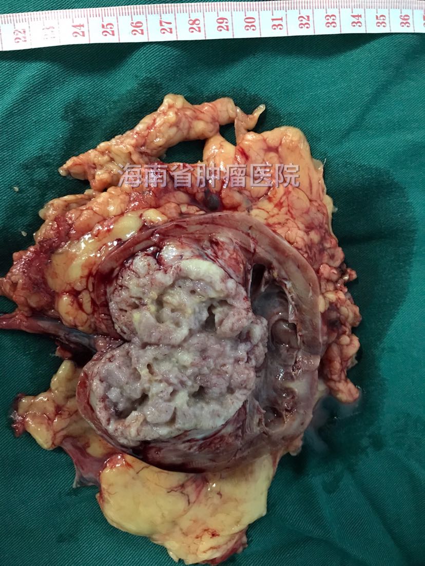 今天科室完成腹腔镜下肾肾盂癌根治术