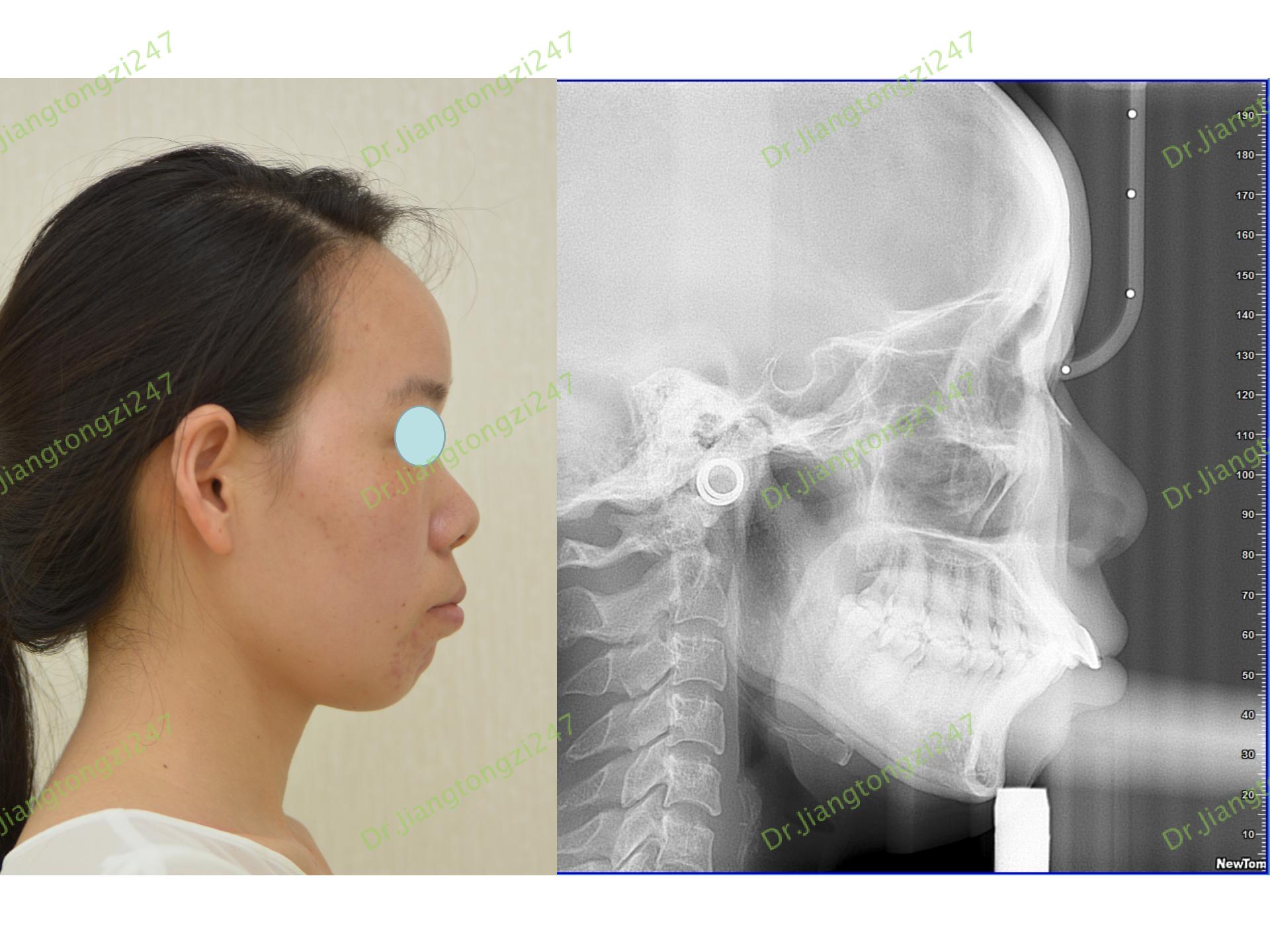 非手术治疗偏颌脸歪的后续改变来了 - 知乎