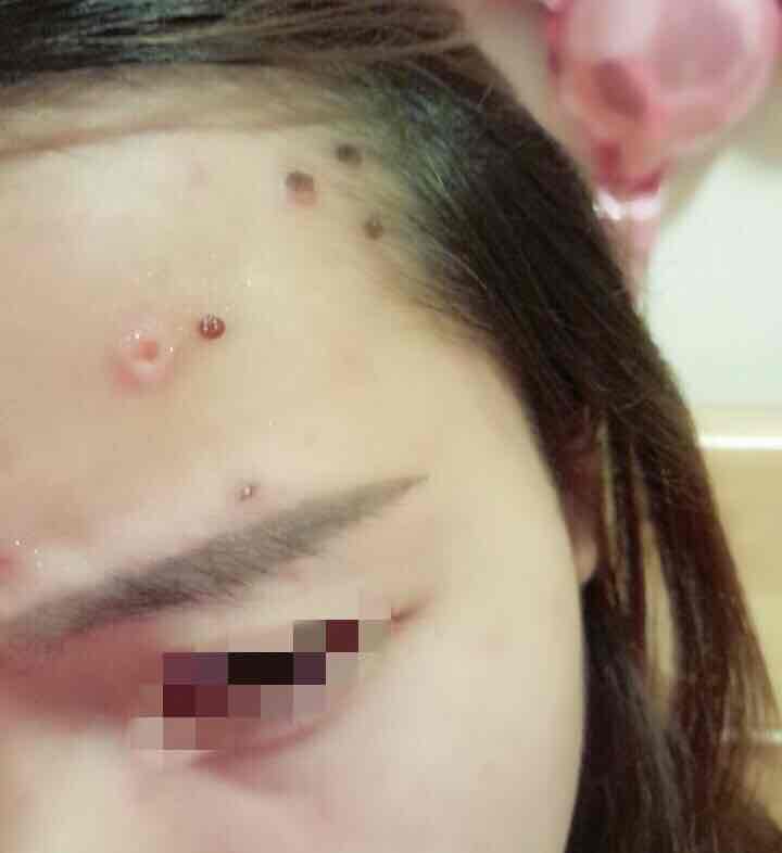 得了水痘坑妆也化不掉怎么办怎么办