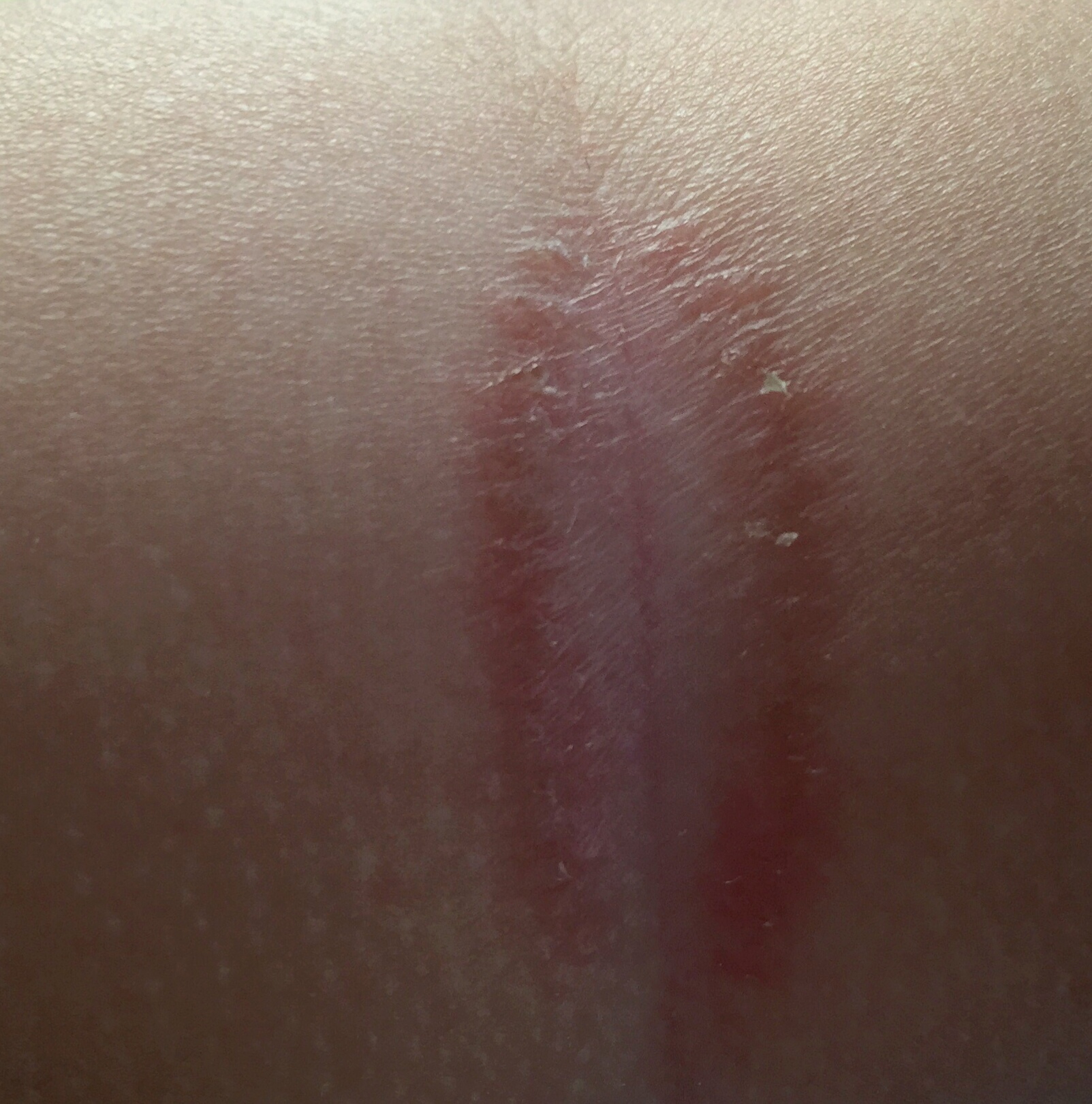 湿气湿疹和保湿