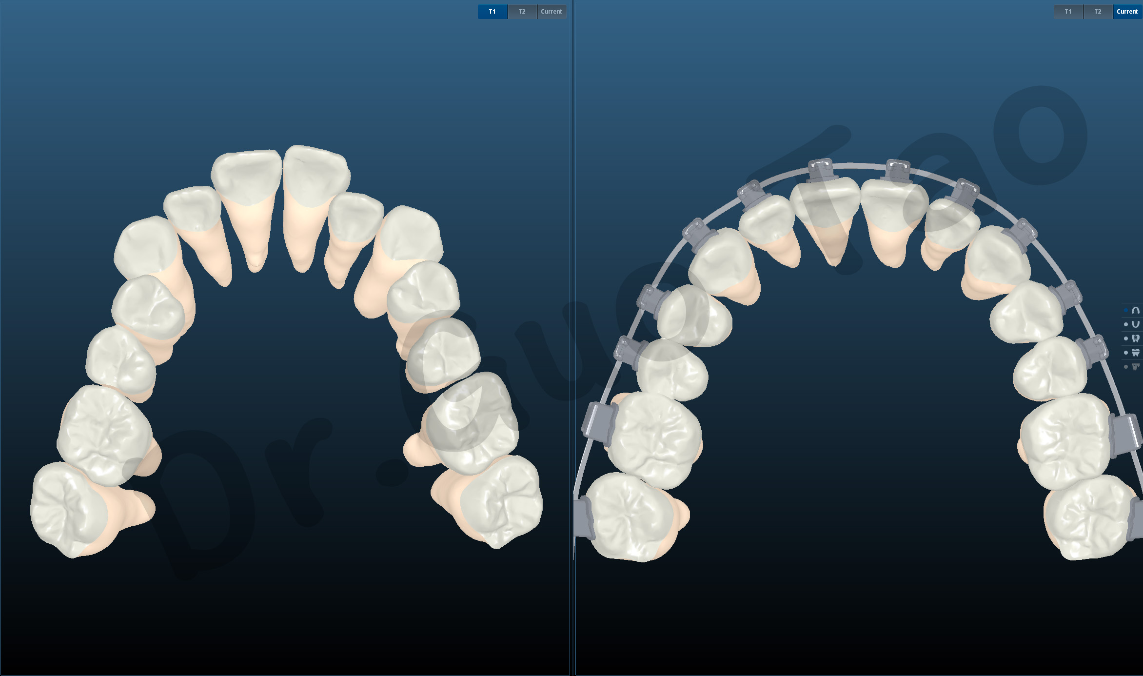 Prostujące nakładki na zęby a aparat ortodontyczny - Hello Smile